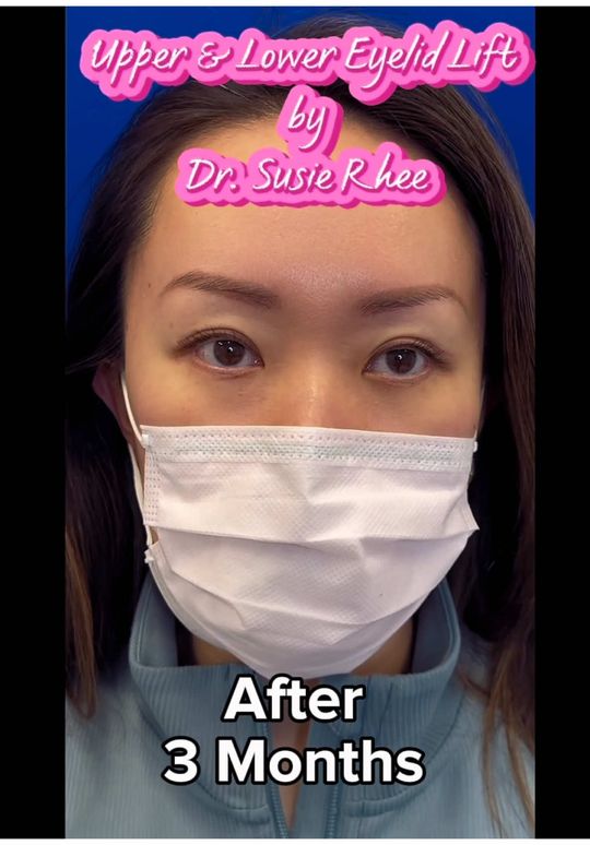 Video by Dr. Susie Rhee: 😍😍😍 Upper & Lower Eyelid Lift (Upper Blepharoplasty, Lower Blepharoplasty with Skin Pinch). Th…