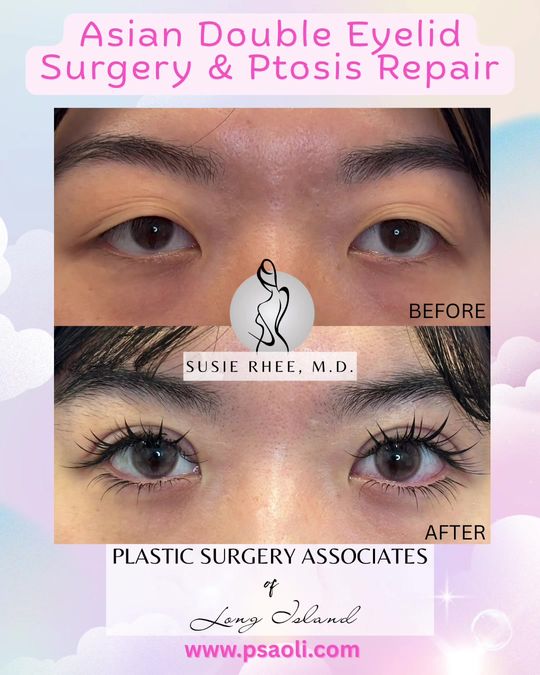 Video by Dr. Susie Rhee: ✨Asian Double Eyelid Surgery✨ Dr. Susie Rhee specializes is eyelid surgeries as well as Asian dou…