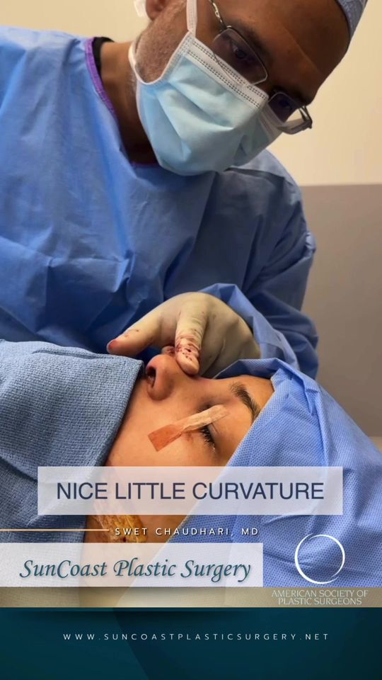 Video by Dr. Swet Chaudhari: Interested in Rhinoplasty? Check out Dr. C as he performs an open rhinoplasty! Part 2 It’s always…