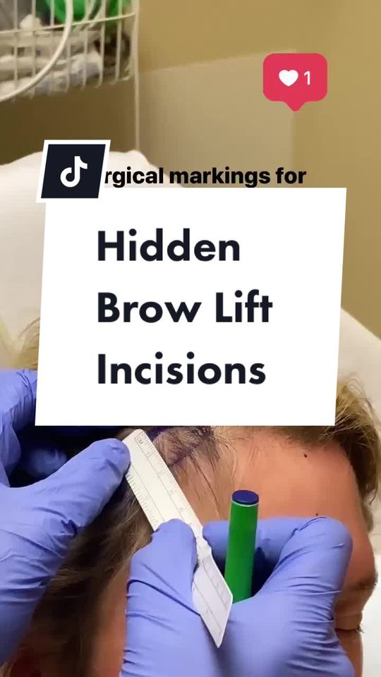 Video by Dr. Tamara Dawli: Brow lift incisions are hidden in the hairline .