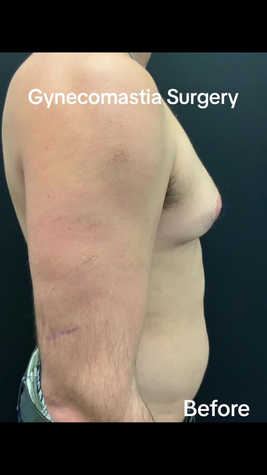 Video by Dr. Tamara Dawli: What is Gynecomastia Surgery? This cosmetic surgery procedure removes excess fat and glandular ti…