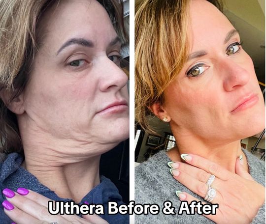 Video by Dr. Tamara Dawli: Ultherapy lift Tight and lifted look 🤩Ulthera treatments tighten the skin and reduce wrinkles. U…