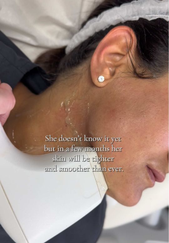 Video by Dr. Tamara Dawli: Sofwave stimulates the skin's production of collagen and elastin, leading to tighter, firmer skin…
