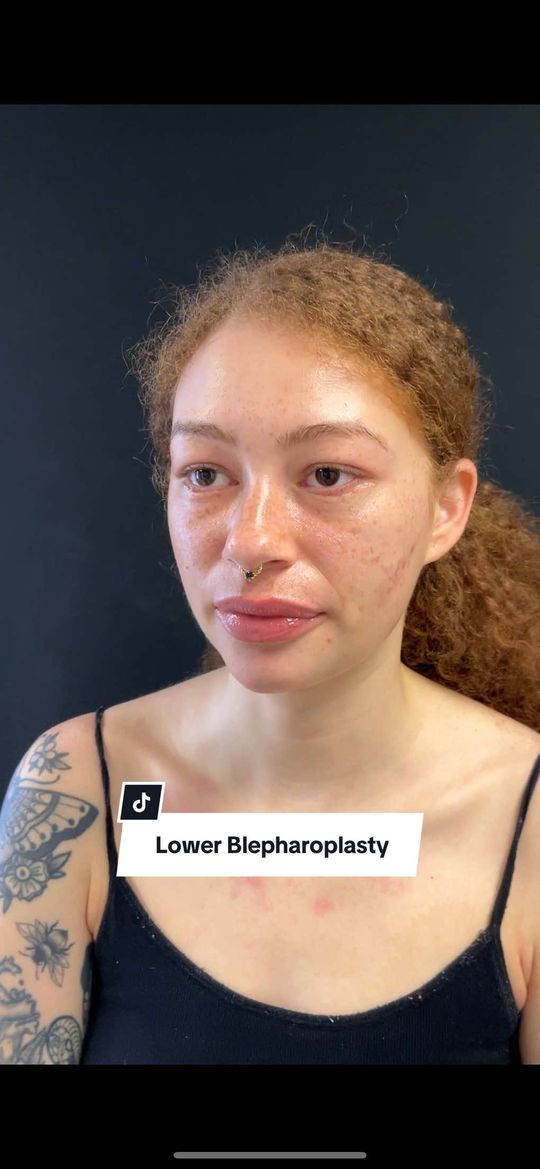 Video by Dr. Tamara Dawli: A lower blepharoplasty is a procedure that aims to improve the appearance of the lower eyelids an…