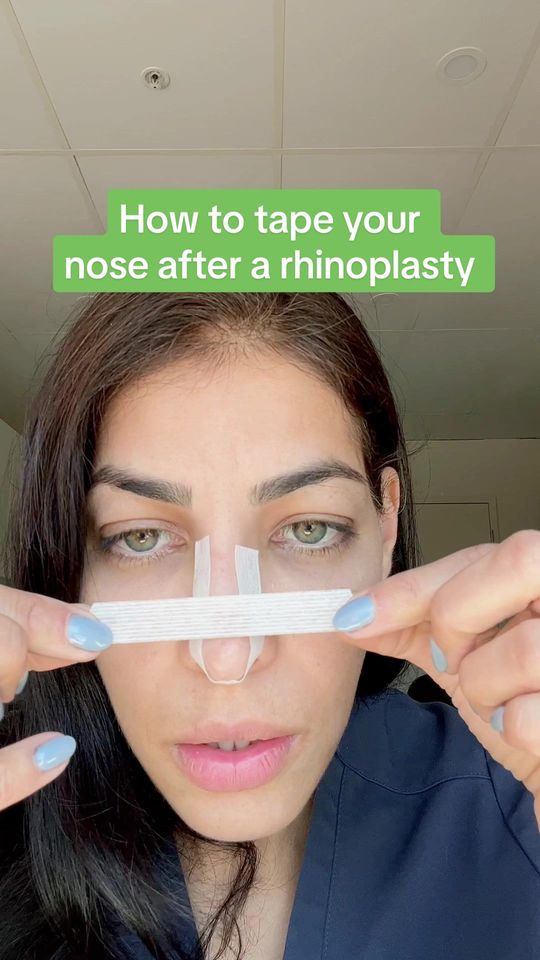 Video by Dr. Tanya Judge: How to tape your nose properly after a rhinoplasty! comment any questions you have below :)