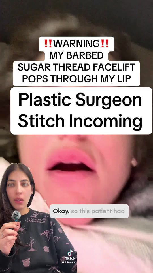Video by Dr. Tanya Judge: with @colbyreneemiller PDO thread fail. PDO threads get a pretty bad rap and this is one of the r…