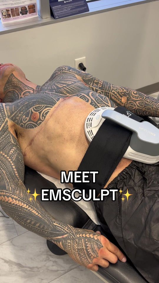 Video by Dr. Tanya Kormeili: Summer transformations are the best with EMSCULPT💜☀️🙏 —AREAS OF TREATMENT INCLUDE: 💪Abdominal…