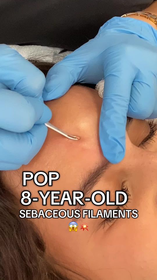 Video by Dr. Tanya Kormeili: 8 YEARS in the making… GONE in minutes! 🤯 Sebaceous filaments might be tiny, but when they build…