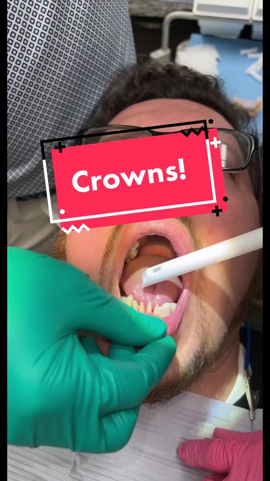 Video by Dr. Todd E. Shatkin: Permanent lower crown placement for Josh!
