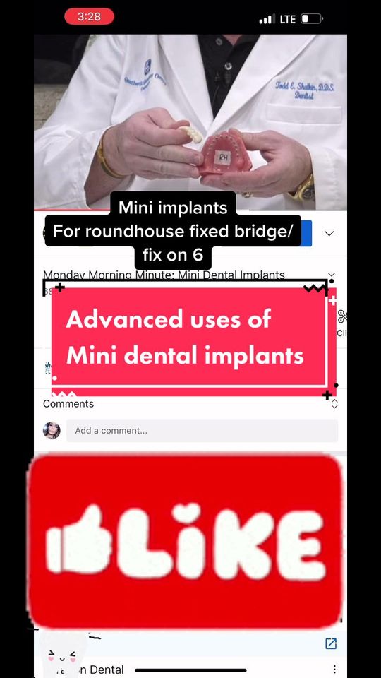 Video by Dr. Todd E. Shatkin: There are so many options when it comes to what we can use these implants for! (716)839-1700 ➡️