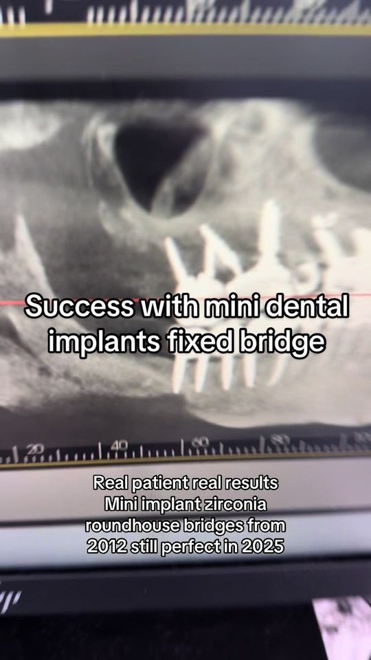 Video by Dr. Todd E. Shatkin: Gail is rocking her mini implant retained zirconia roundhouse bridges from 2012 into 2025! You ca…