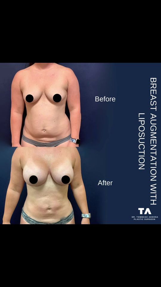 Video by Dr. Tommaso Addona: After two children, this patient was able to regain a flatter stomach and fuller breasts with the…