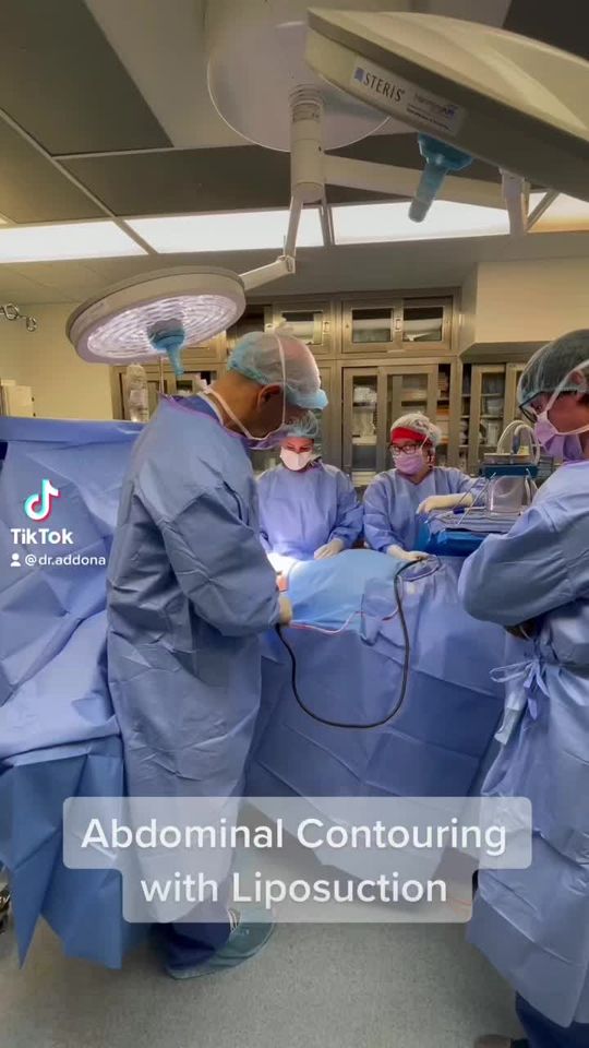 Video by Dr. Tommaso Addona: Abdominal Contouring with Liposuction