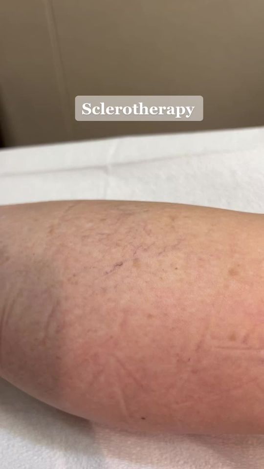 Video by Dr. Toni Stockton: Sclerotherapy right before your eyes!
