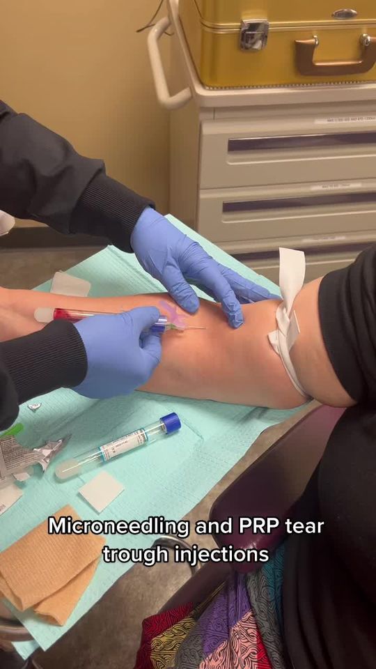 Video by Dr. Toni Stockton: PRP injections for the tear troughs supports a more youthful appearance with a decrease of hollow…