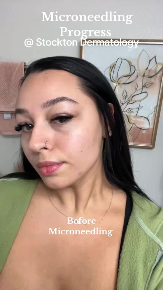 Video by Dr. Toni Stockton: The process of healing after a Microneedling treatment here with us at Stockton Dermatology. Call…