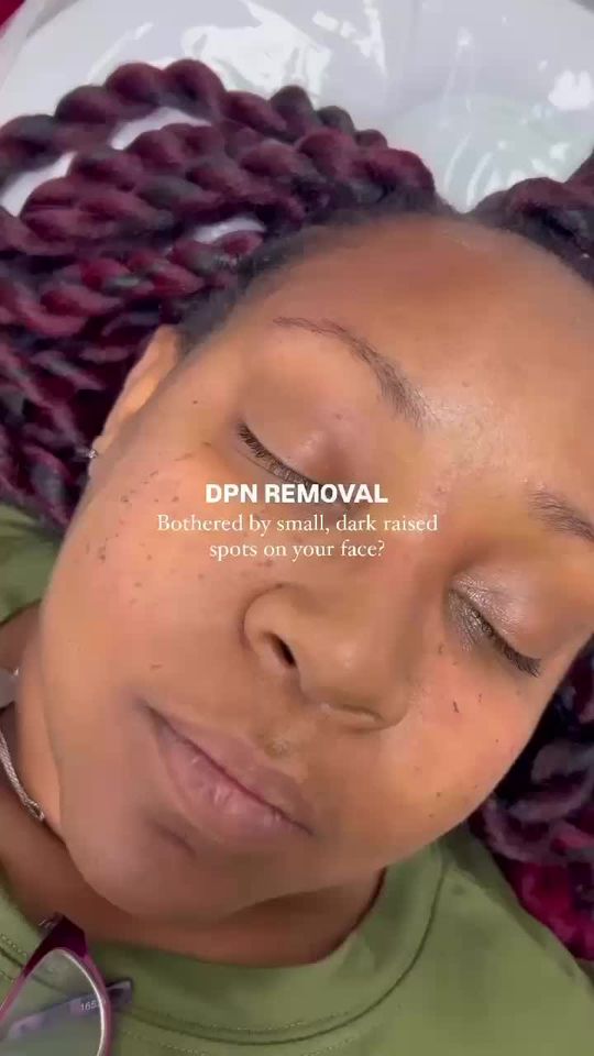 Video by Dr. Toni Stockton: Do you have small, dark, raised spots on your face that look like tiny moles or skin tags? 👇🏻 T…