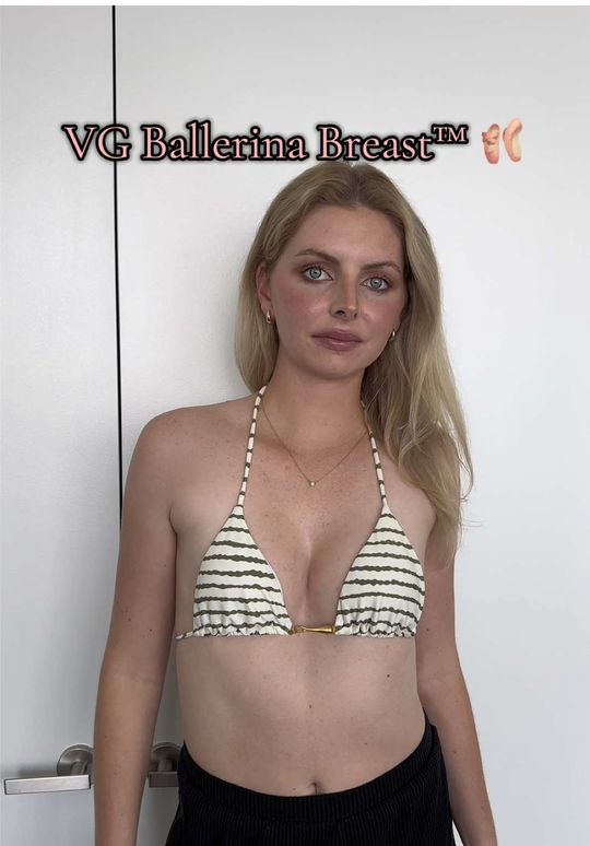 Video by Dr. Vipul Gargya: ✨ The VG Ballerina Breast - grace, precision, and proportion. She didn’t want “big.” She wanted b…