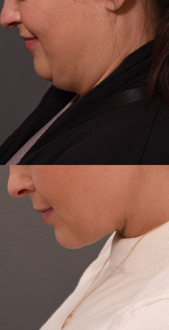 Video by Dr. Vito C. Quatela: The procedure that’s taking over our practice- Deep Neck Contouring!