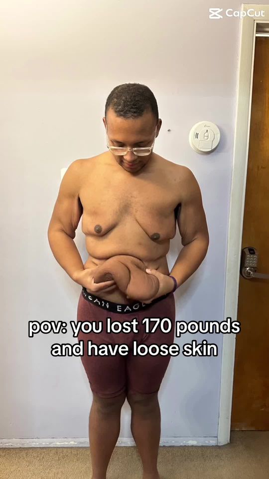 Video by Dr. Vito C. Quatela: Bariatric Surgery ➡️ 170 pound weight loss ➡️ plastic surgery to remove excess skin ➡️ 🔥🔥🔥🔥