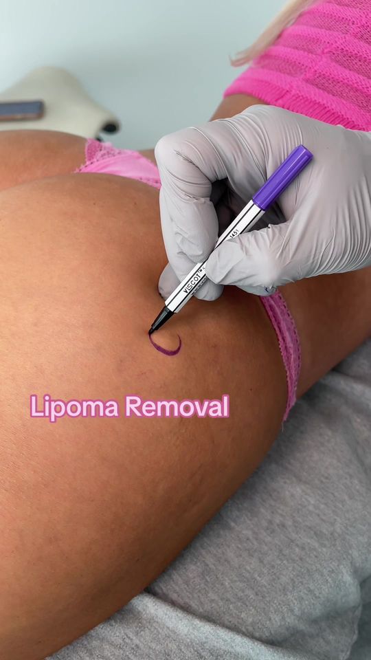 Video by Dr. Walter Joseph: Lipomas are benign fatty growths that some people get. Some people can have many of these. The tr…