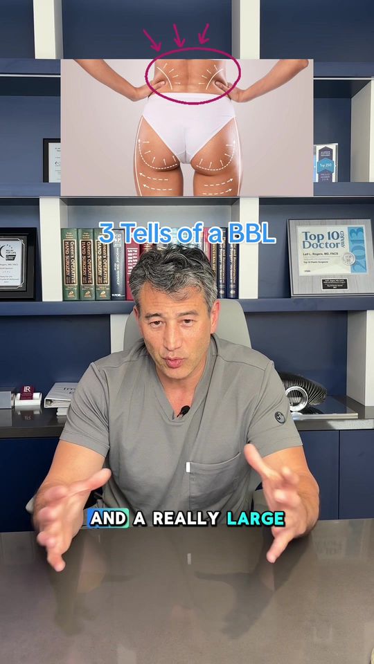 Video by Dr. Walter Joseph: Replying to @em How can you tell when someone has a bbl? 🍑 Here are just a few things to look fo…