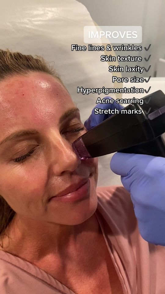 Video by Dr. Wesley G. Schooler: MORPHEUS8 is the 🔑 to gorgeous & glowing skin ✨