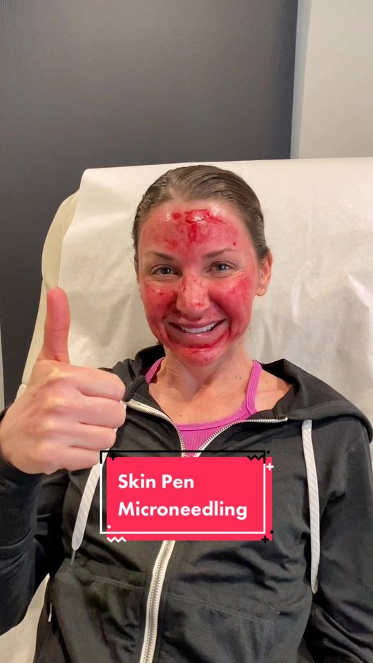 Video by Dr. Wesley G. Schooler: Skin Pen Microneedling Treatment 💉🩸
