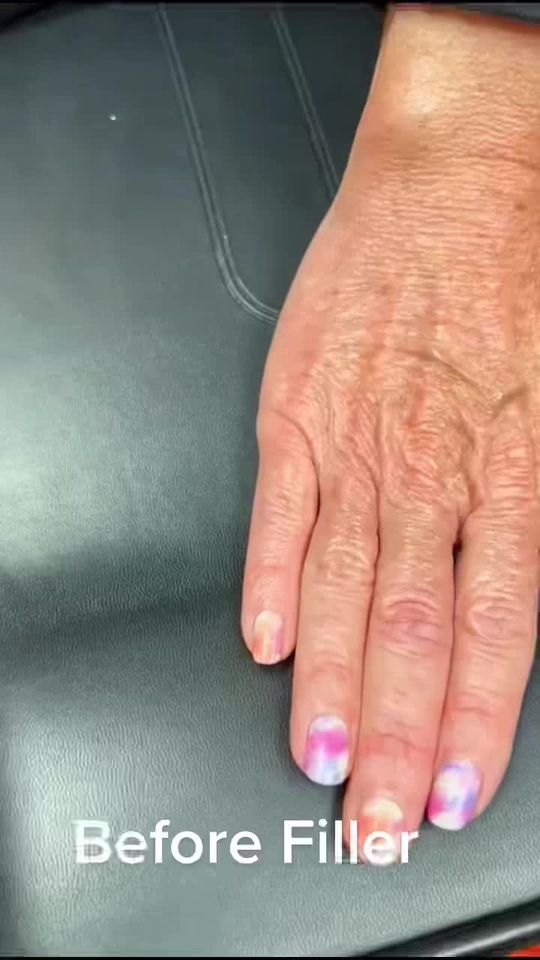 Video by Dr. William A. Wallace: Did you know your hands show your age!? Add some youthfulness with filler.