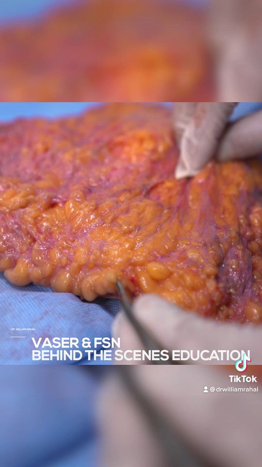 Video by Dr. William Rahal: What is Vaser Liposuction and why is it used during a BBL?