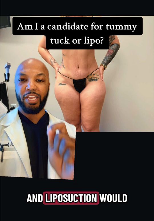 Video by Dr. Wright Jones: Patients need to understand the pros and cons of liposuction vs Tummy Tucks. We spend a great dea…