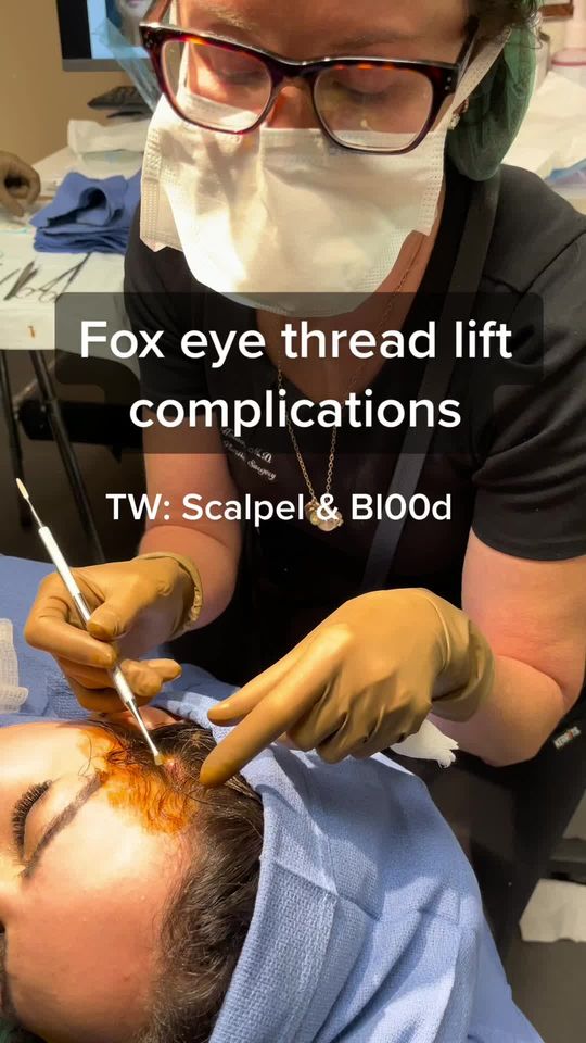 Video by Dr. Yael Halaas: The extremely popular fox eye trend is not risk free. Using threads in this particular area of th…
