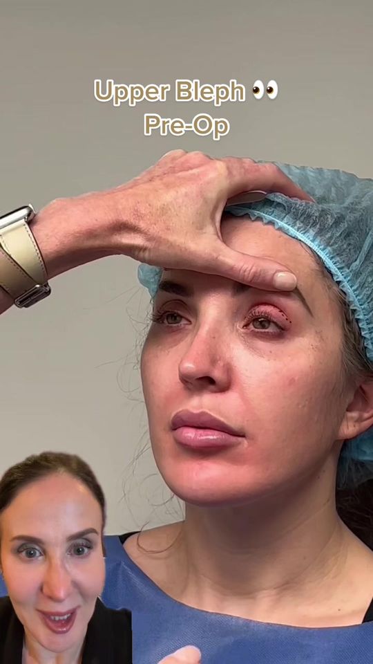 Video by Dr. Yael Halaas: This is essential to a perfect blepharoplasty. This ensures that we are removing enough skin but…