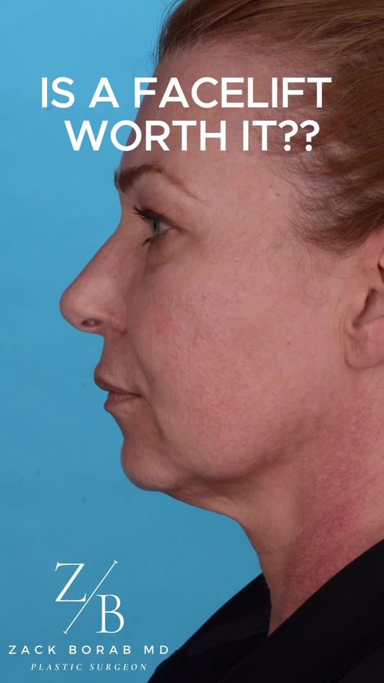 Video by Dr. Zachary Borab: When is a face lift worth it? If you have loose neck skin, jowling, or decent of your mid face th…