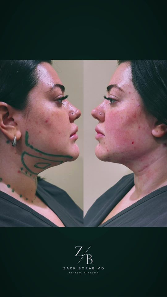 Video by Dr. Zachary Borab: Say goodbye to unwanted under chin fat! I performed this submental (chin/neck) liposuction under…