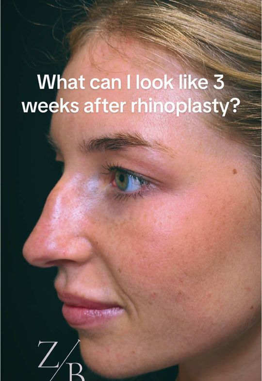 Video by Dr. Zachary Borab: Concerned about bruising and swelling after a rhinoplasty?? Rhinoplasty or nose job surgery today…