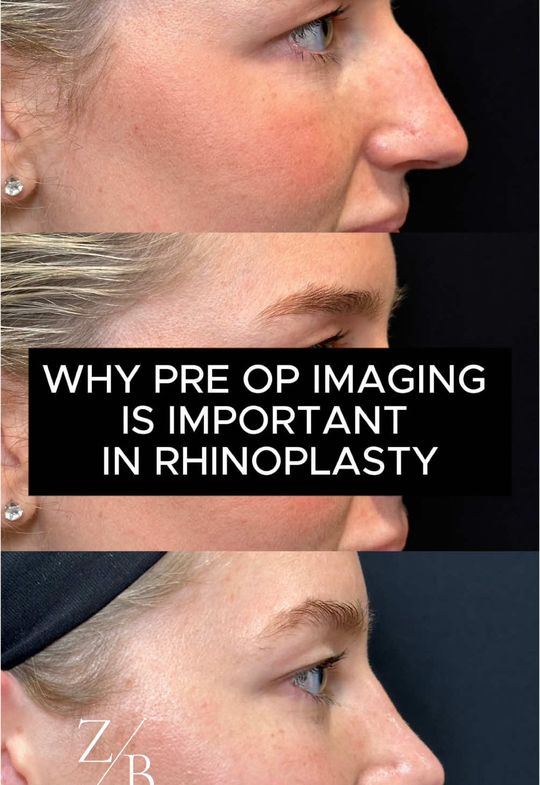 Video by Dr. Zachary Borab: What will I look like after a rhinoplasty?? Photo simulations are a super important tool that I u…