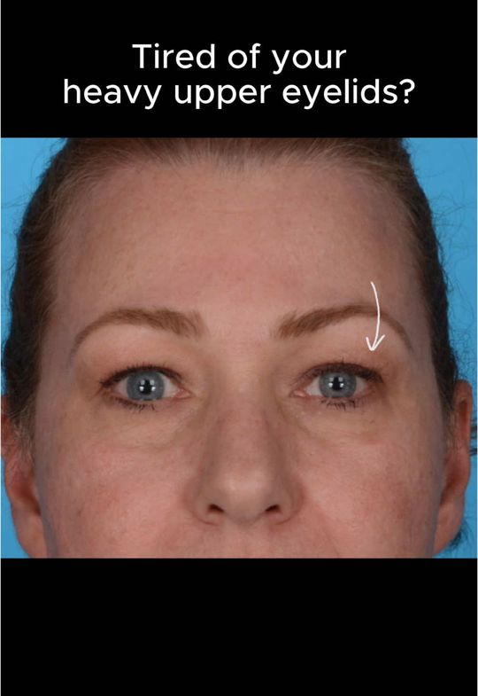 Video by Dr. Zachary Borab: Tired of heavy of upper eyelids?? An upper blepharoplasty is a very safe and effective option to…