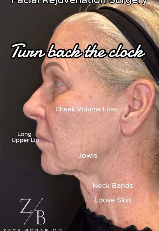 Video by Dr. Zachary Borab: Comprehensive Face Lift Surgery! This lovely patient is only 6 weeks from her comprehensive facia…