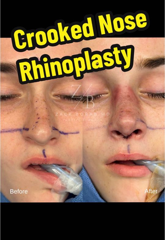 Video by Dr. Zachary Borab: CROOKED NOSE RHINOPLASTY! This 20-year-old patient developed a congenital “reverse C shape” devia…