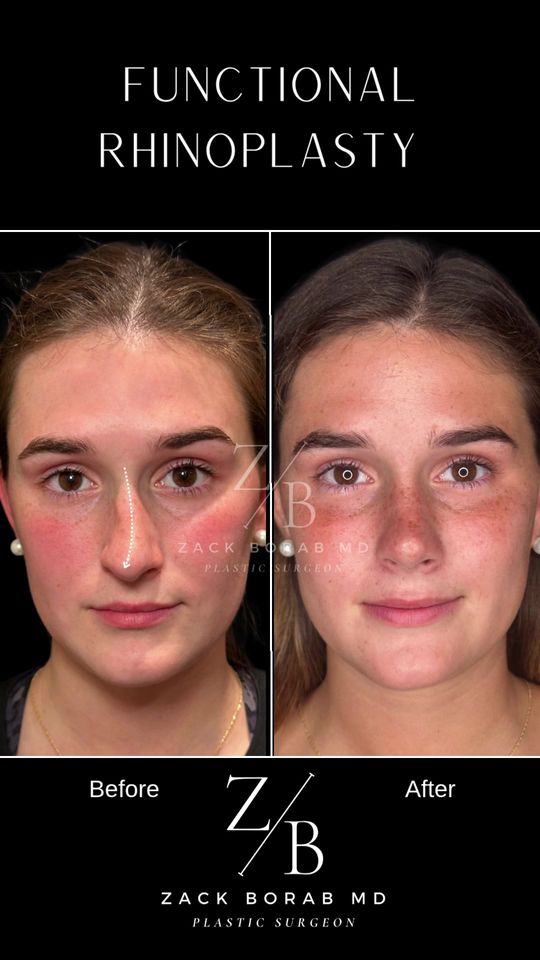Video by Dr. Zachary Borab: 👃✨ **Before & After: Functional + Aesthetic Rhinoplasty** ✨👃 This 20-year-old patient came to u…