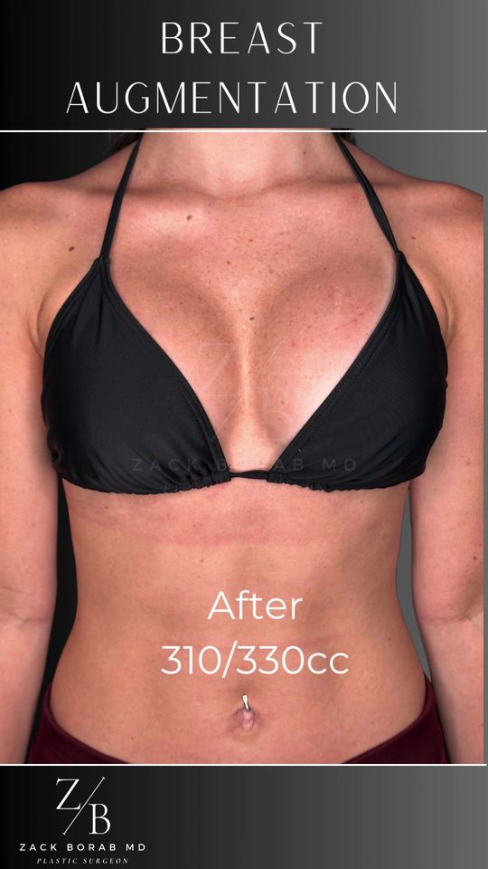 Video by Dr. Zachary Borab: ✨ Before & After: Breast Augmentation ✨ This fit and active 22-year-old patient came to us wantin…